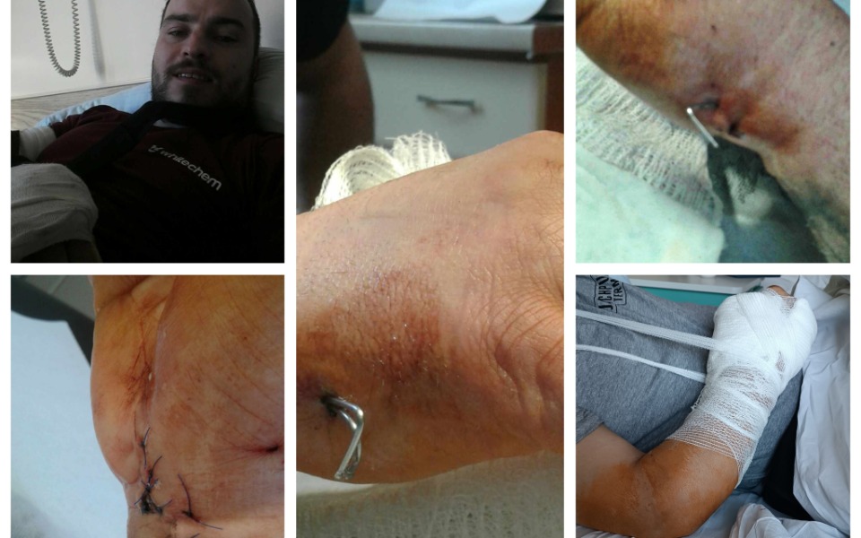 
        Zdjęcia rany na dłoni po wypadku, z opatrunkiem.
    