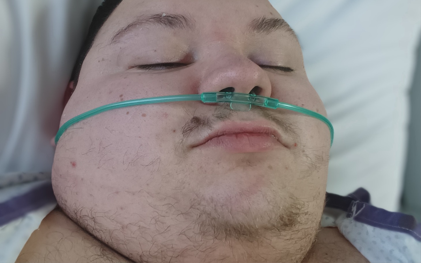 
        Mężczyzna w szpitalu z tlenem na nosie.
    