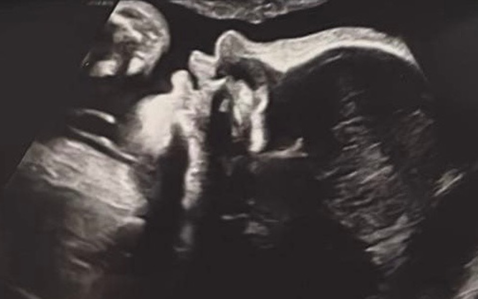 
        Ultrasonografia pokazująca rozwijające się dziecko.
    