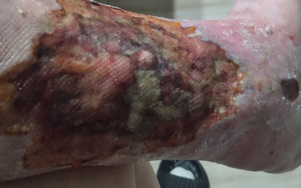 
        Rana na nodze z widocznymi oznakami gojenia.
    