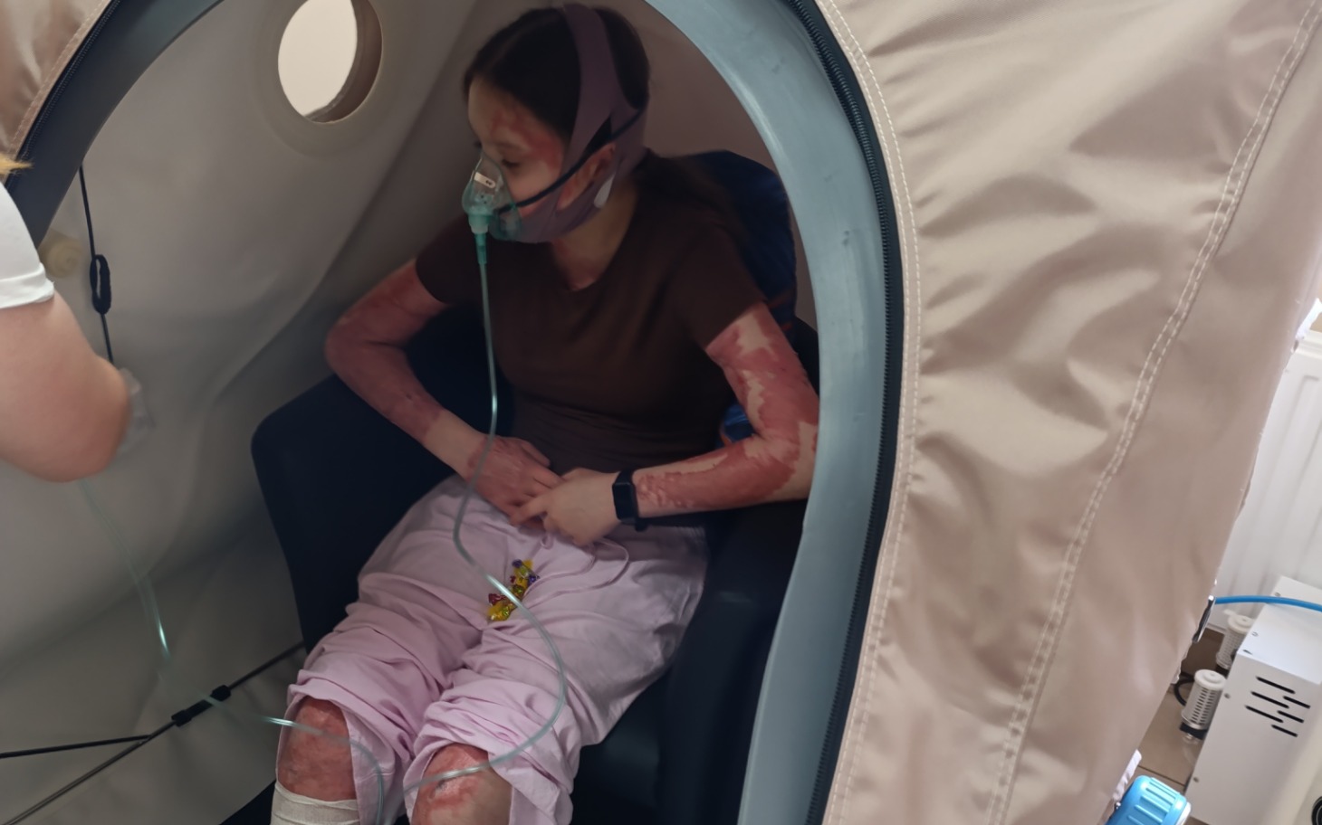 
        Kobieta w komorze tlenowej, z widocznymi poparzeniami na ciele.
    