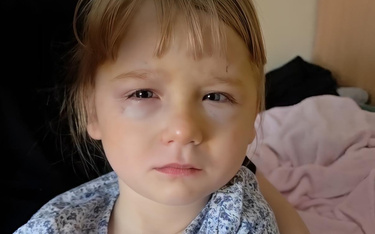 
        Dziecko z siniakiem na twarzy, wygląda na zmartwione.
    