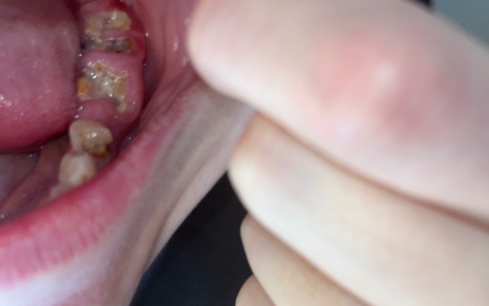 
        Zdjęcie wnętrza jamy ustnej z widocznymi zębami.
    