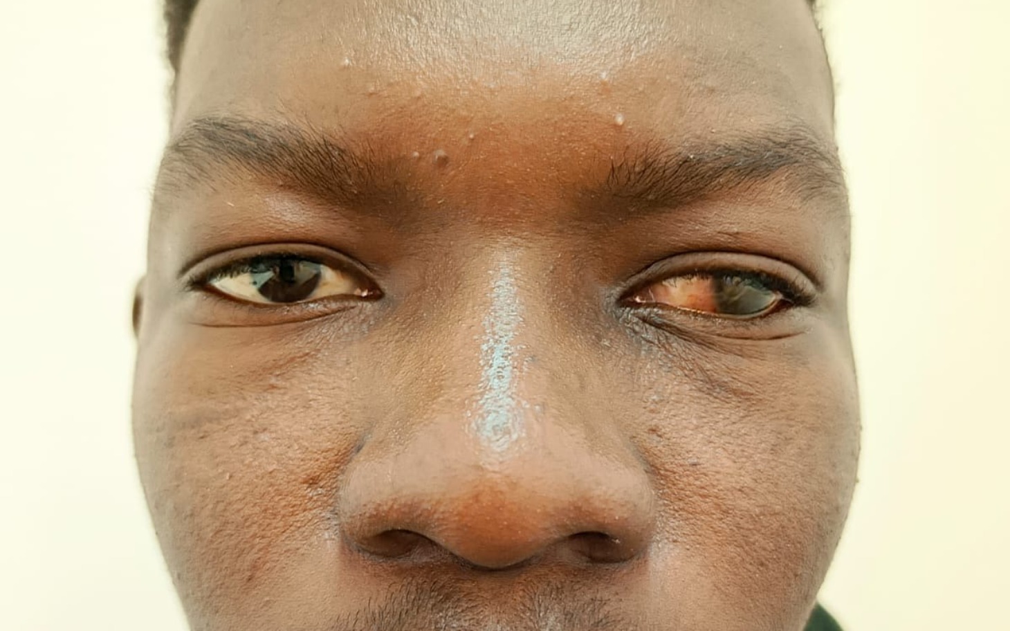 
        Mężczyzna z problemem zdrowotnym oczu.
    