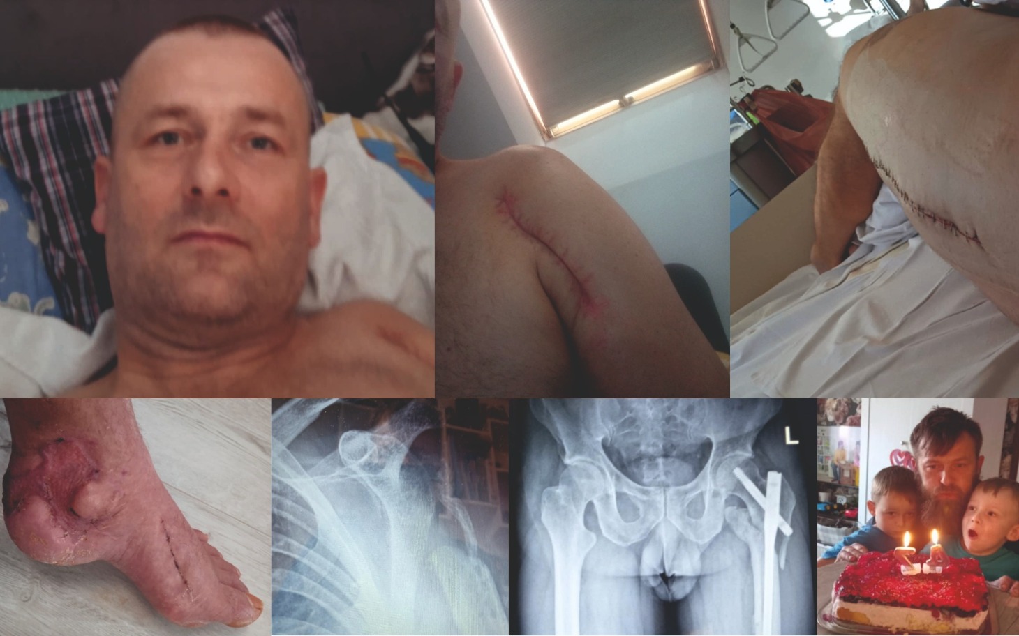 
        Mężczyzna leżący w łóżku, z widocznymi bliznami na ciele.
    