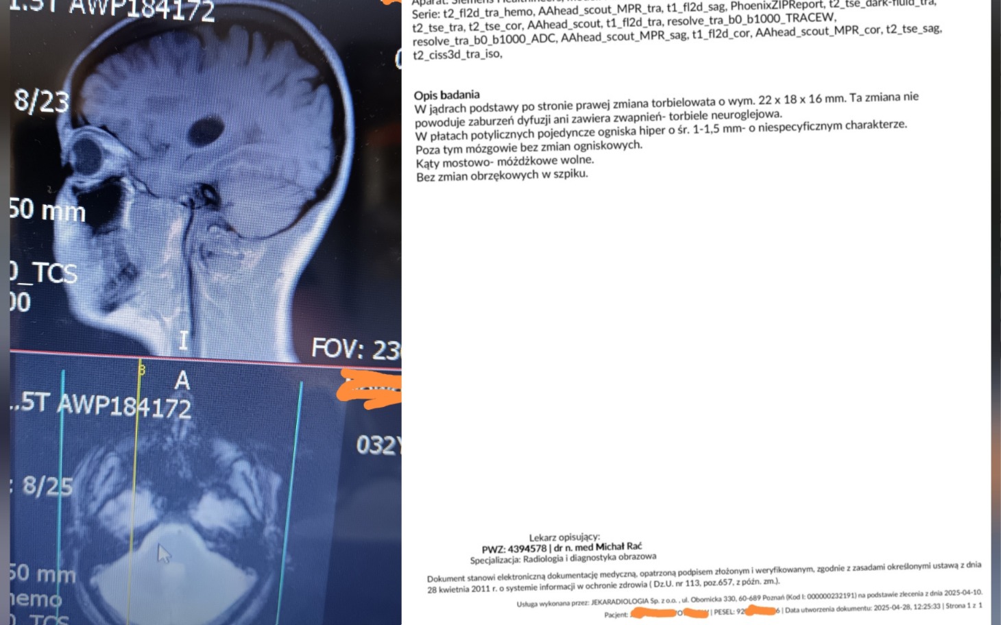 
        Zdjęcie MRI z opisem medycznym, na białym tle.
    