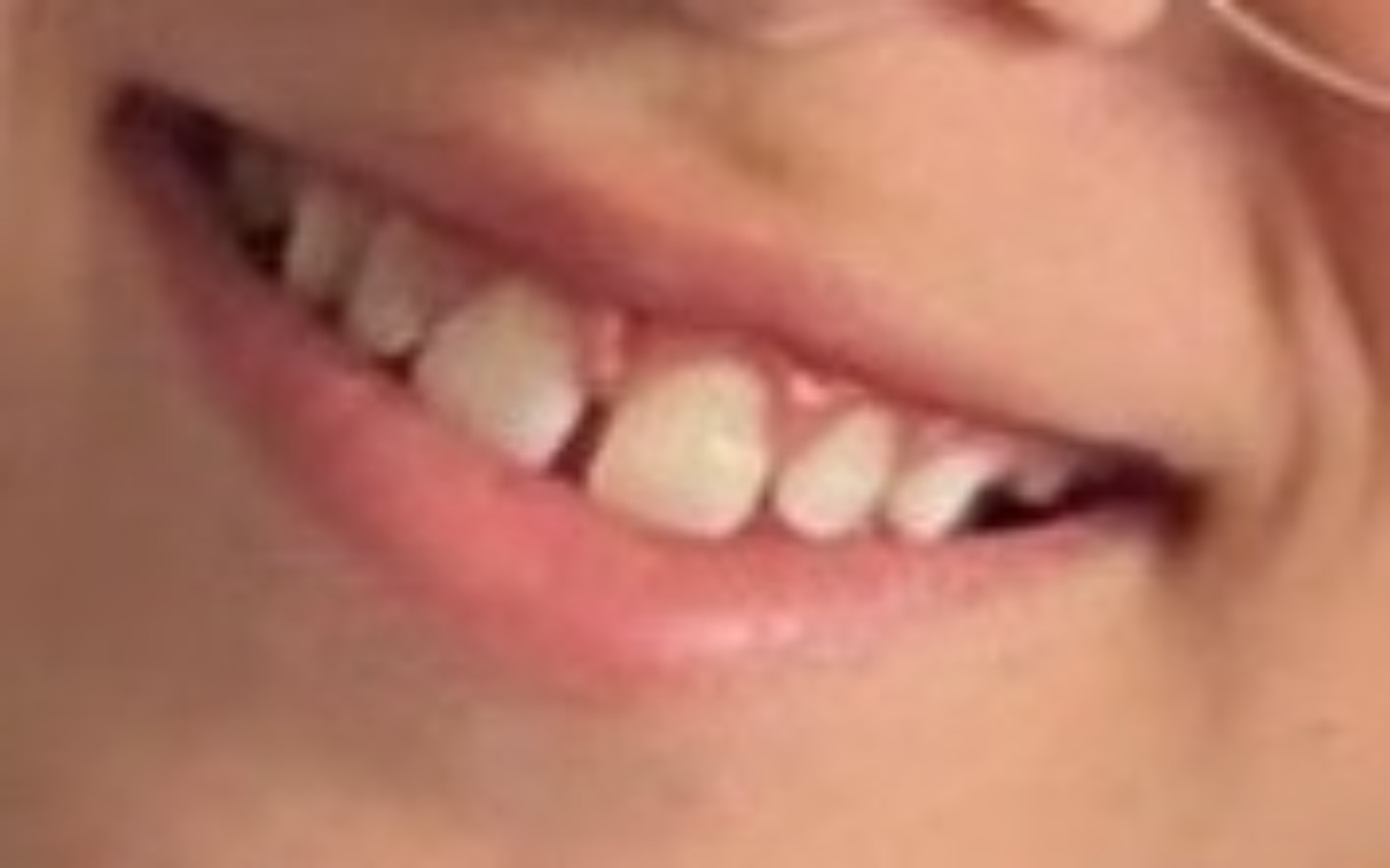 
        Zbliżenie na uśmiech z widocznymi zębami.
    