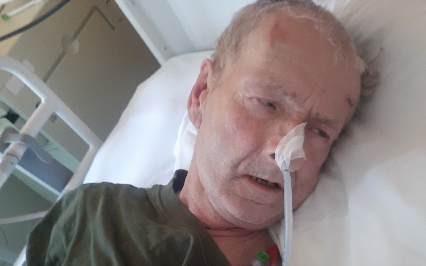
        Mężczyzna w szpitalnym łóżku, z rurką tlenową w nosie.
    