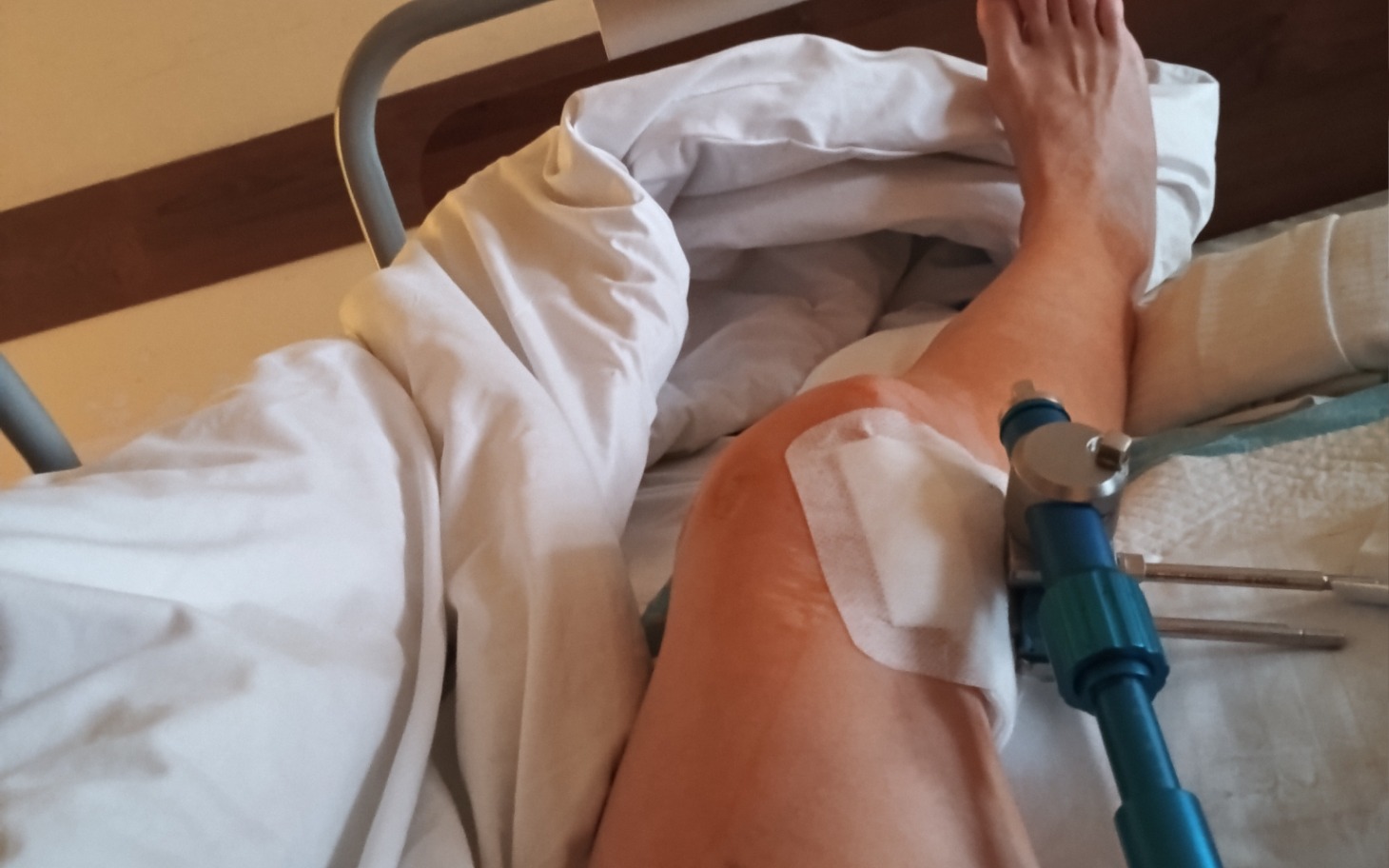 
        Osoba po operacji kolana, leżąca w łóżku szpitalnym.
    