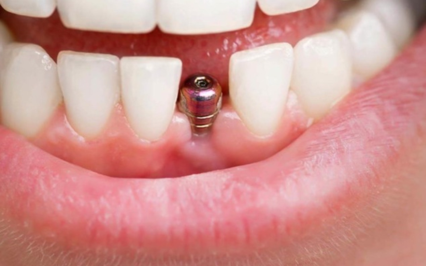 
        Zbliżenie na ząb z implantem dentystycznym.
    