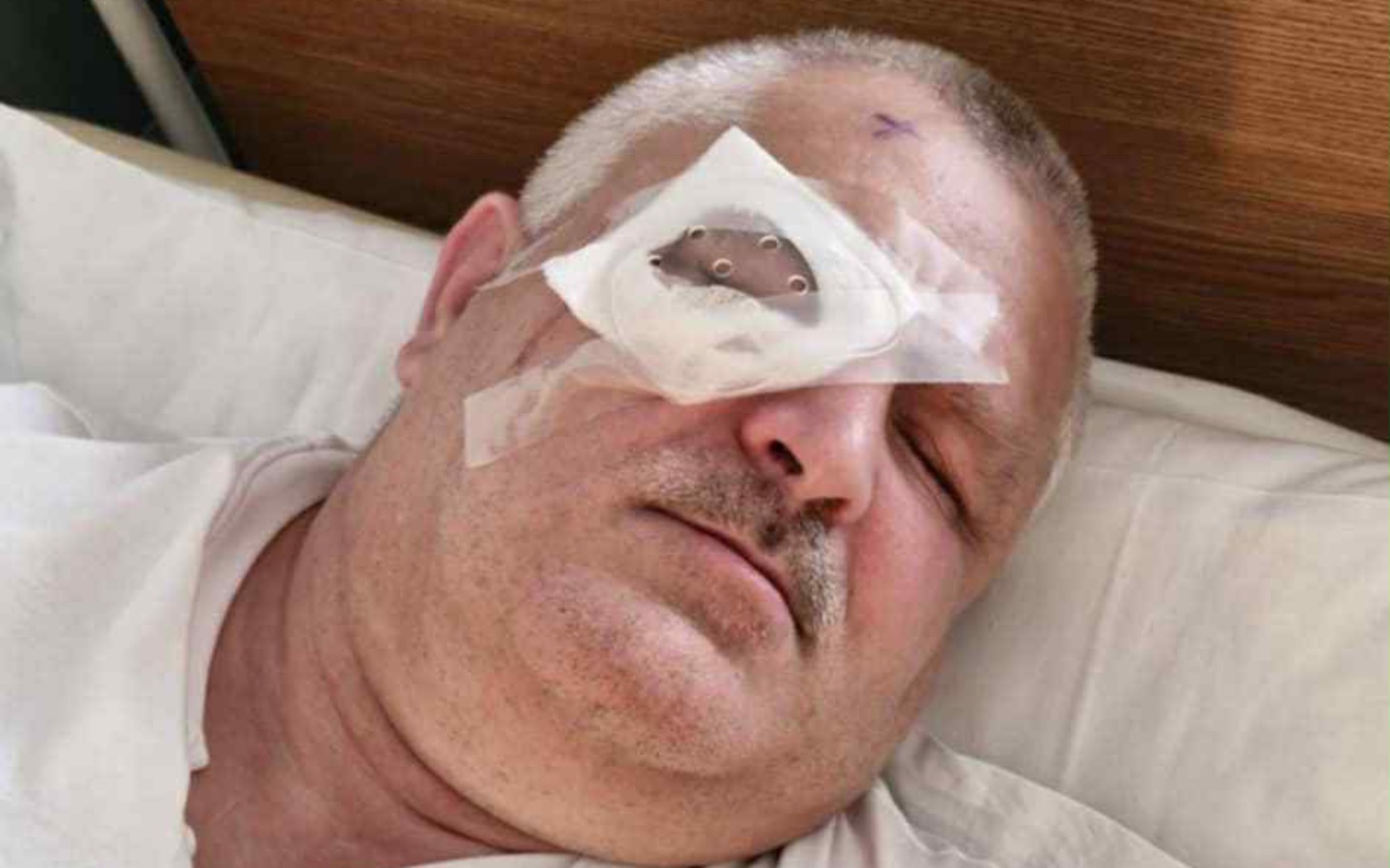 
        Mężczyzna w szpitalu po operacji, z opatrunkiem na oku.
    