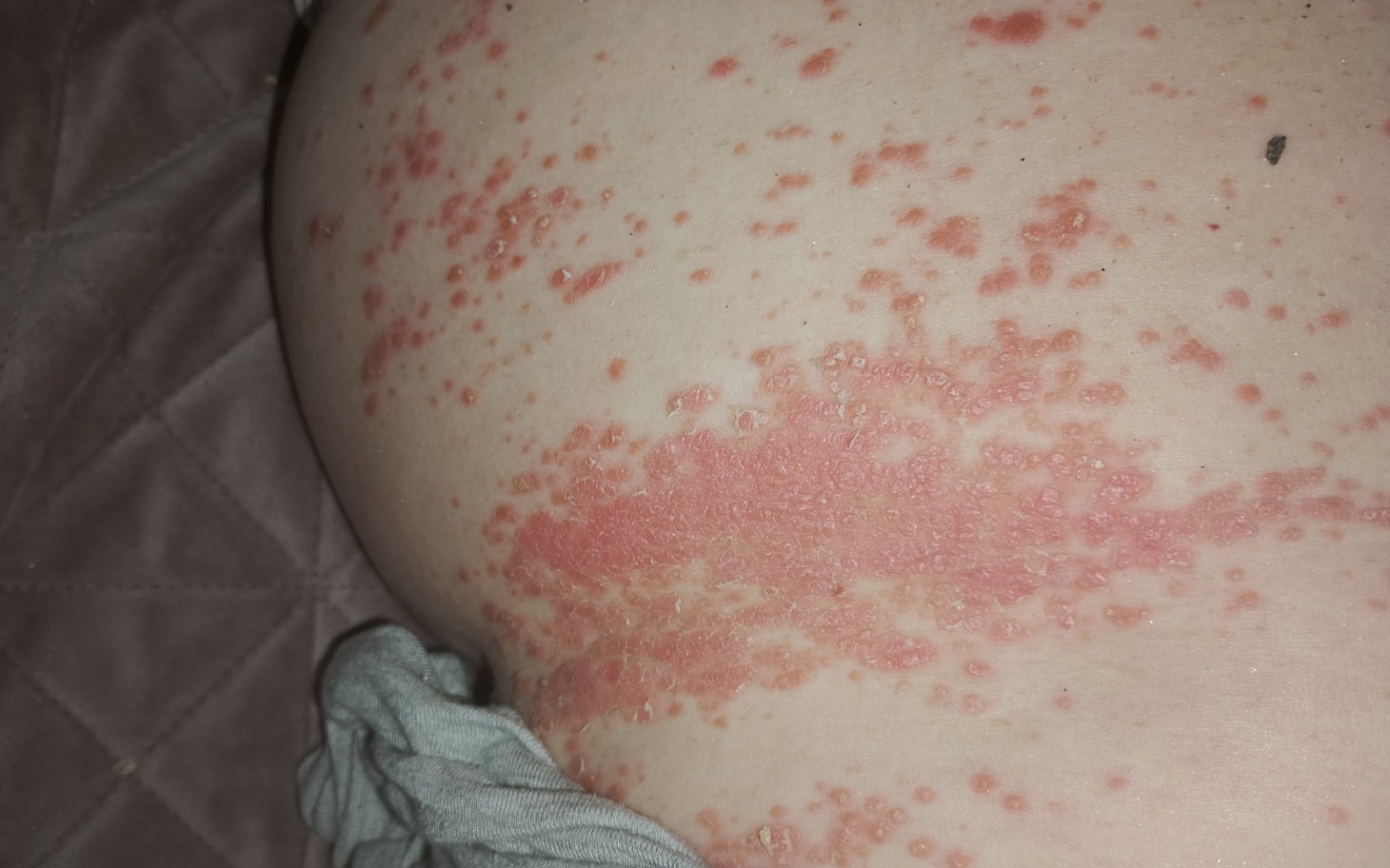 
        Skóra z wysypką, pokazująca objawy choroby dermatologicznej.
    