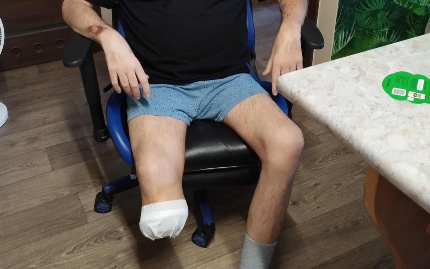 
        Mężczyzna siedzący na krześle z opatrunkiem na nodze.
    