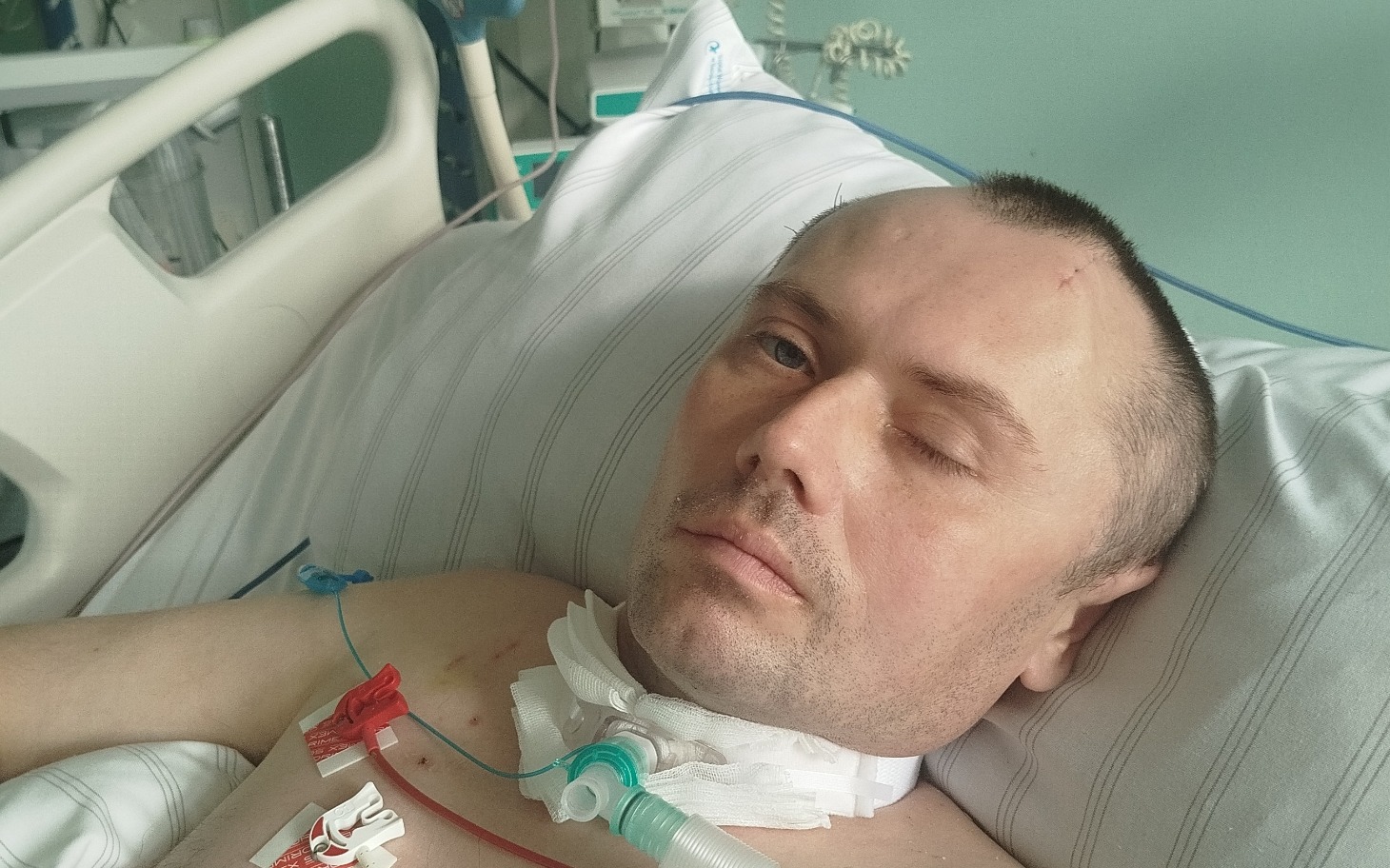 
        Mężczyzna leżący w szpitalnym łóżku, z rurkami medycznymi.
    
