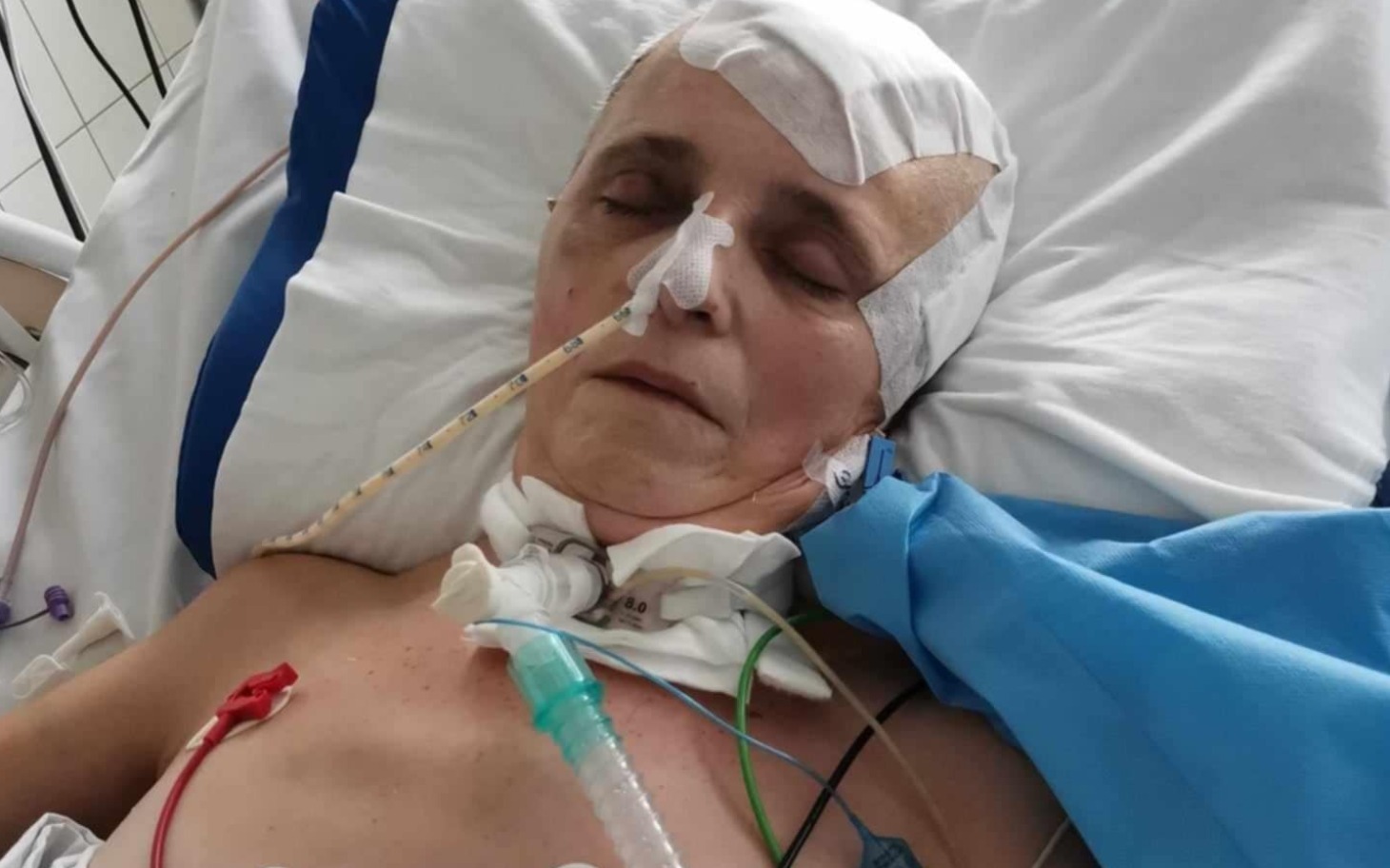 
        Kobieta leży w szpitalu, podłączona do aparatury medycznej.
    
