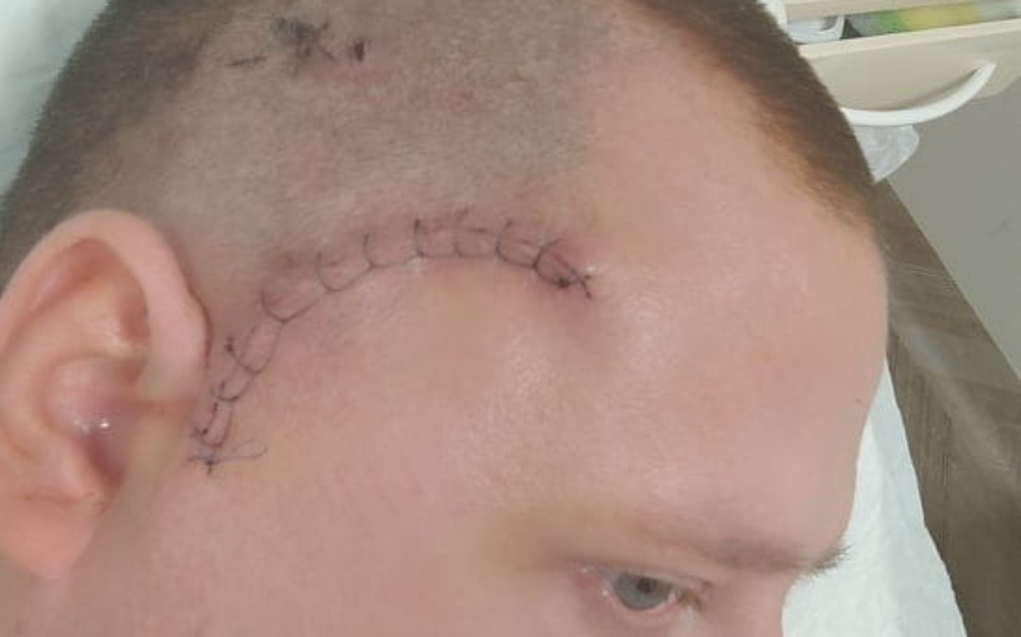 
        Mężczyzna z opatrunkiem na głowie po operacji.
    