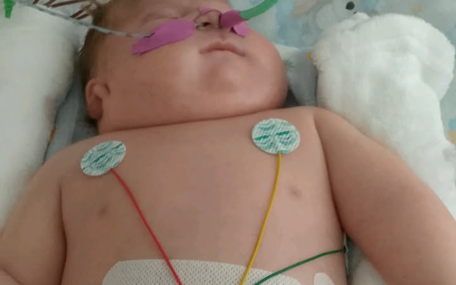 
        Noworodek z elektrodami na klatce piersiowej.
    
