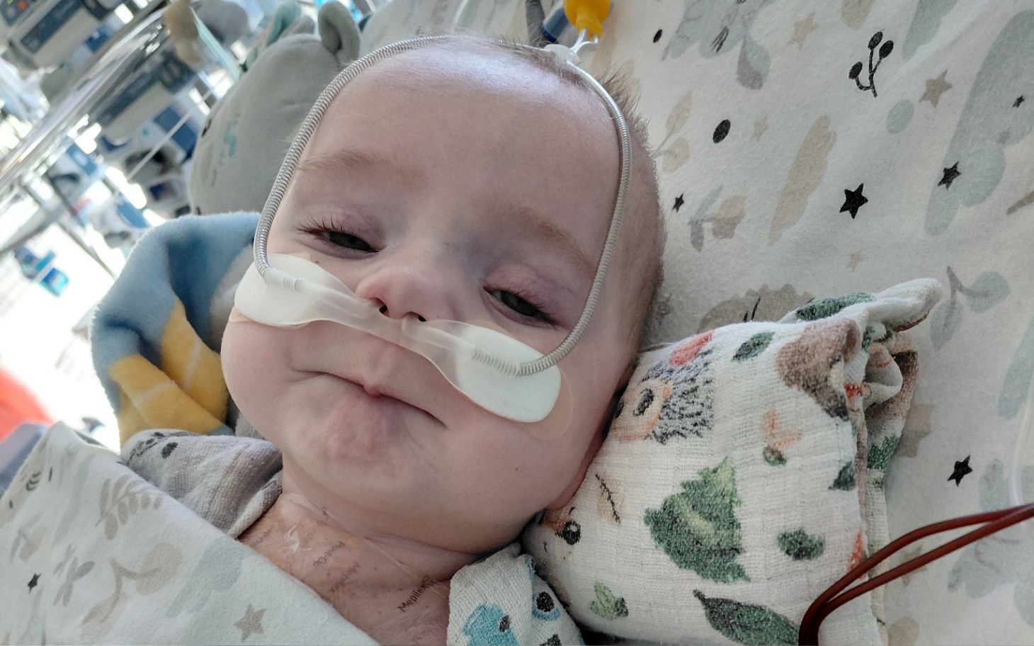 
        Małe dziecko w szpitalu z rurką tlenową na twarzy.
    