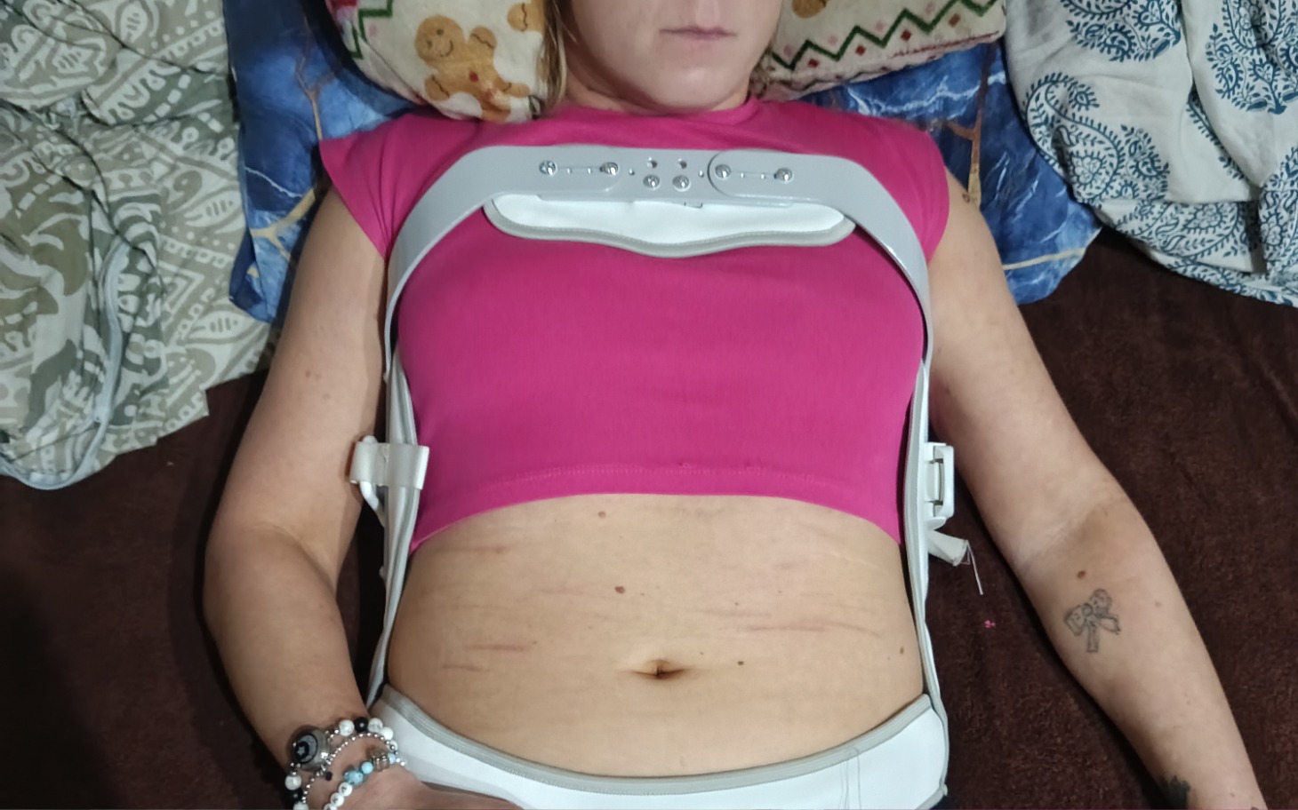 
        Kobieta w różowej bluzce z aparatem ortopedycznym na ciele.
    