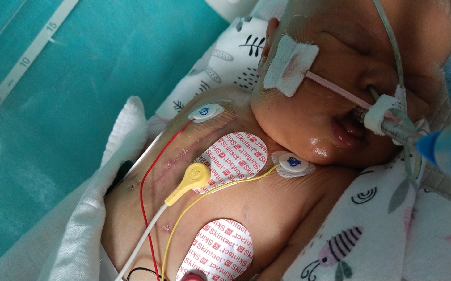 
        Noworodek w szpitalu z monitorami medycznymi.
    