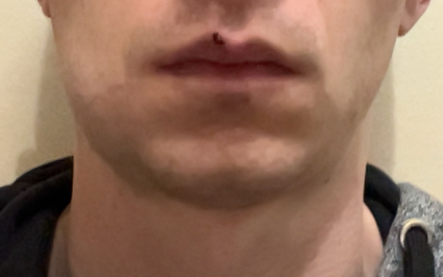 
        Mężczyzna z widoczną raną na ustach, z blizną po urazie.
    