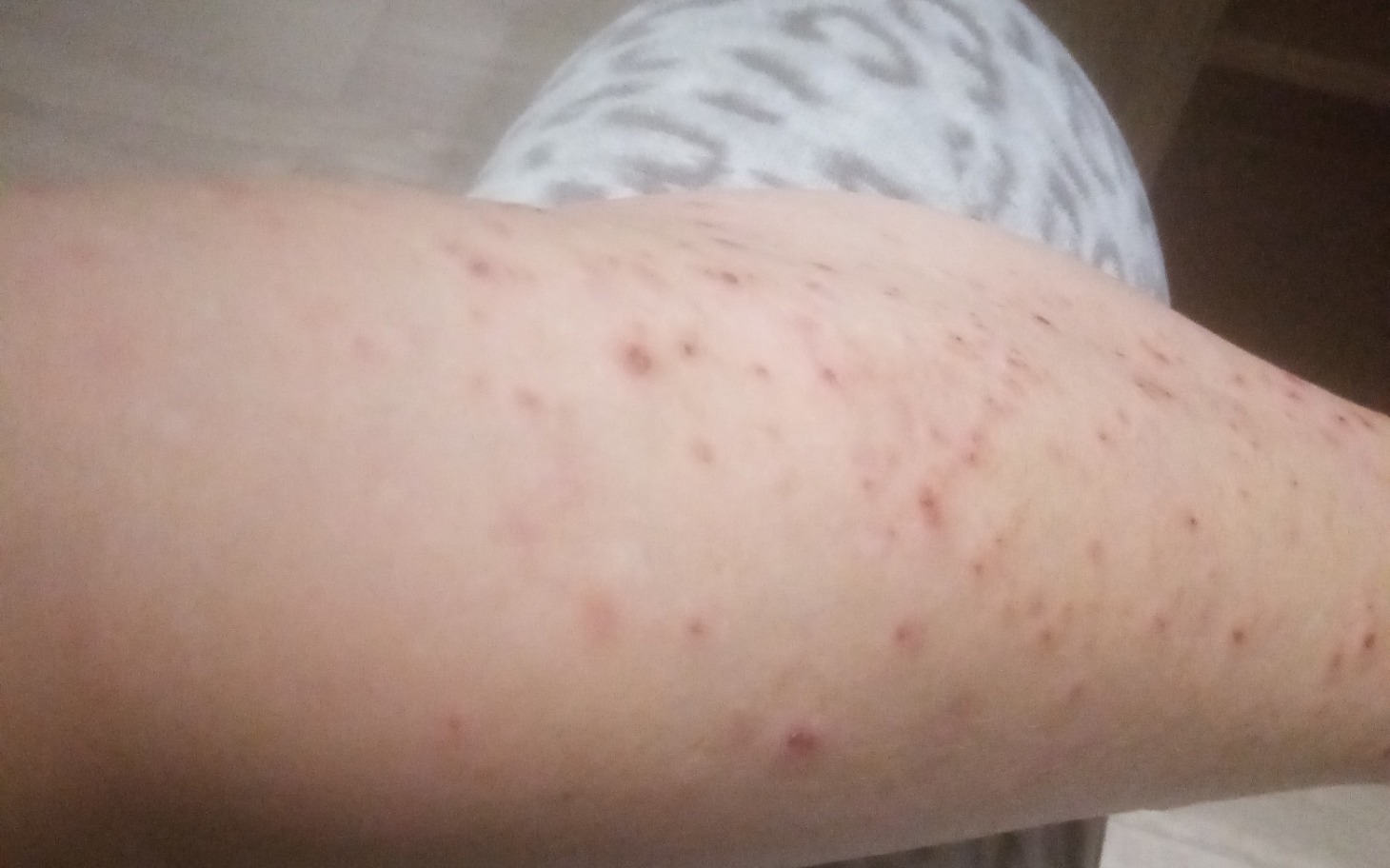 
        Skóra z widocznymi zmianami, prawdopodobnie alergicznymi.
    