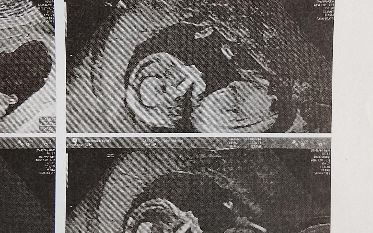 
        Obrazek z badania USG, przedstawiający rozwijający się płód.
    