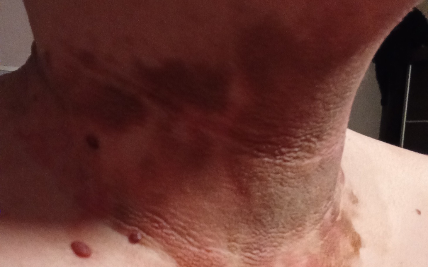 
        Zbliżenie na uszkodzoną skórę na szyi, widoczne blizny i podrażnienia.
    