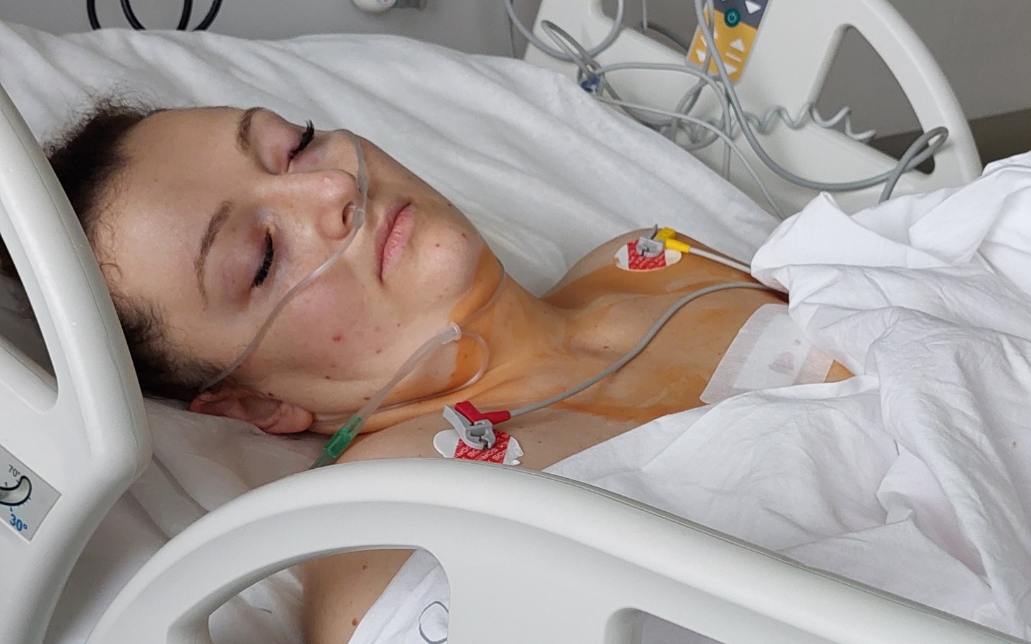 
        Kobieta leżąca w szpitalu, z rurkami tlenowymi na twarzy.
    