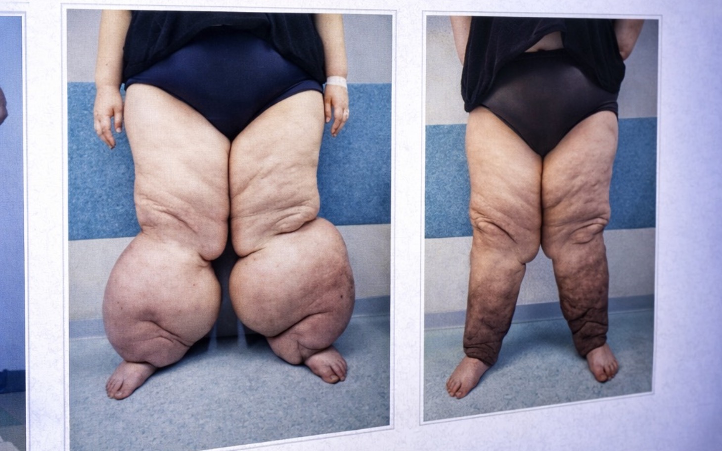 Porównanie nóg przed i po leczeniu.