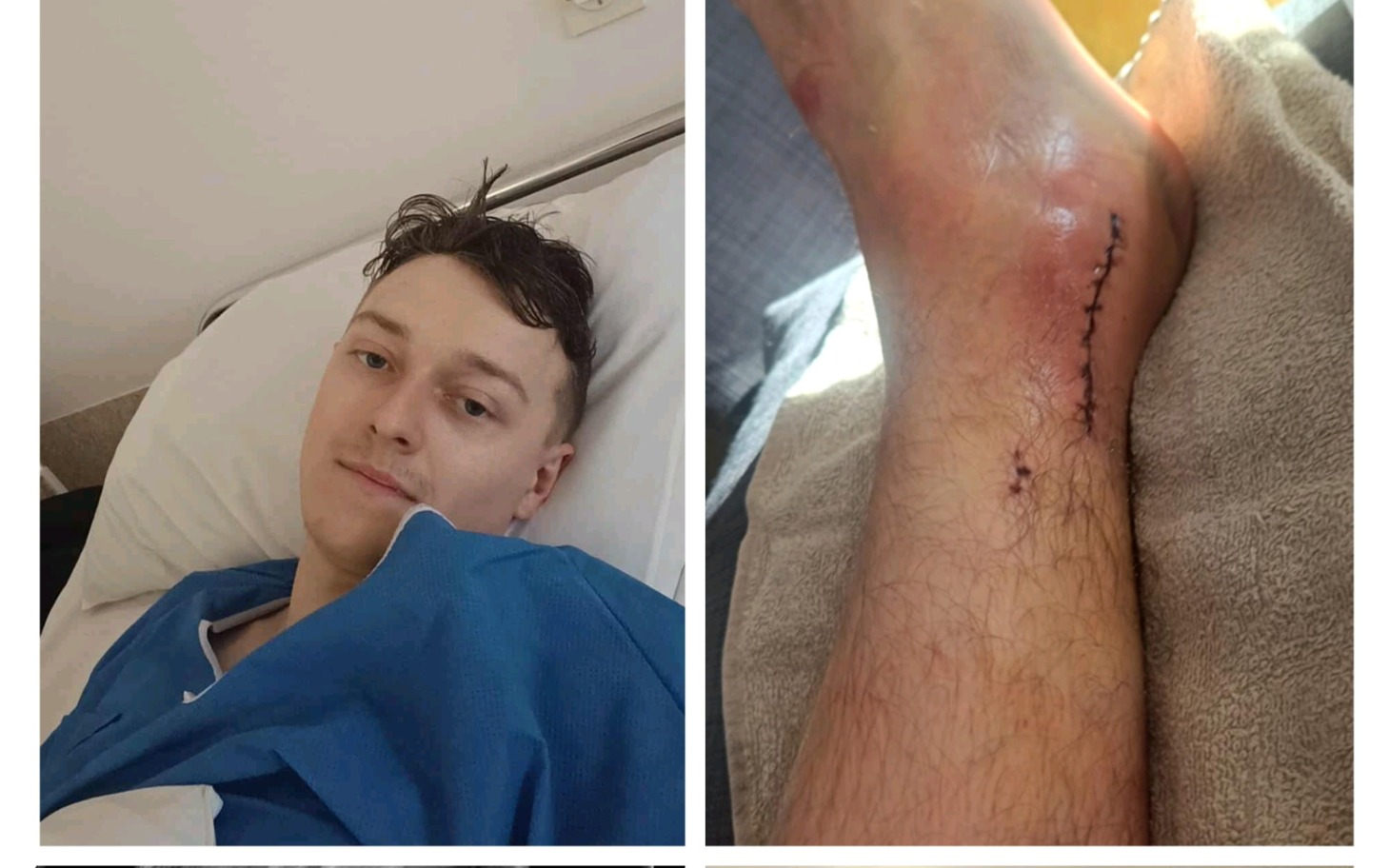 
        Mężczyzna w szpitalu po operacji, z opatrunkiem na nodze.
    