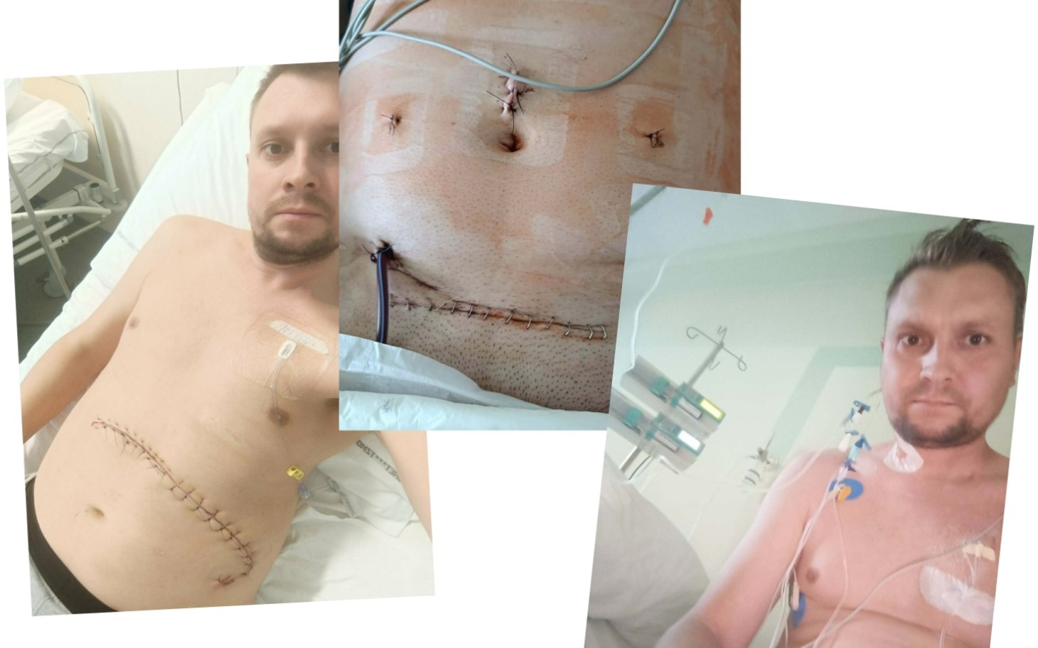 
        Mężczyzna po operacji, z widocznymi szwami na brzuchu.
    