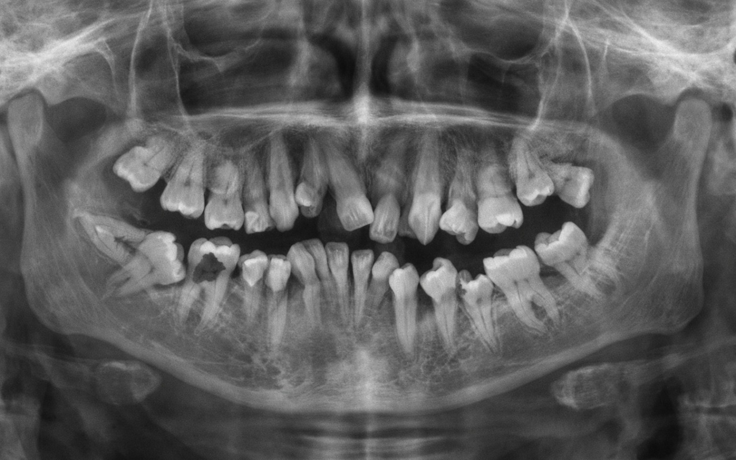 
        Zdjęcie rentgenowskie zębów, ukazujące uzębienie.
    