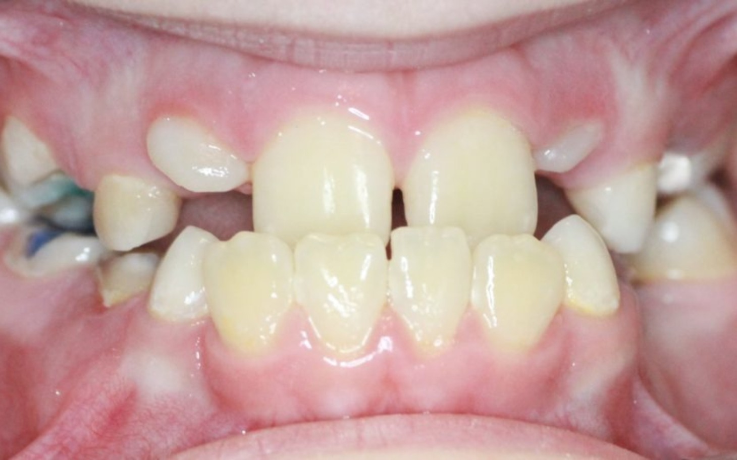 
        Widok na zęby z problemami ortodontycznymi.
    