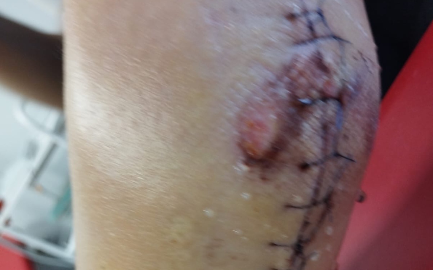 
        Zbliżenie na ranę pooperacyjną na łokciu.
    