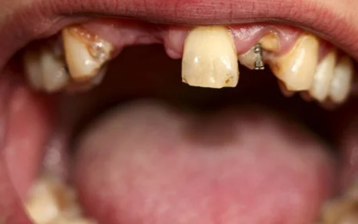 
        Zbliżenie na usta z brakującymi zębami, ukazujące problemy dentystyczne.
    