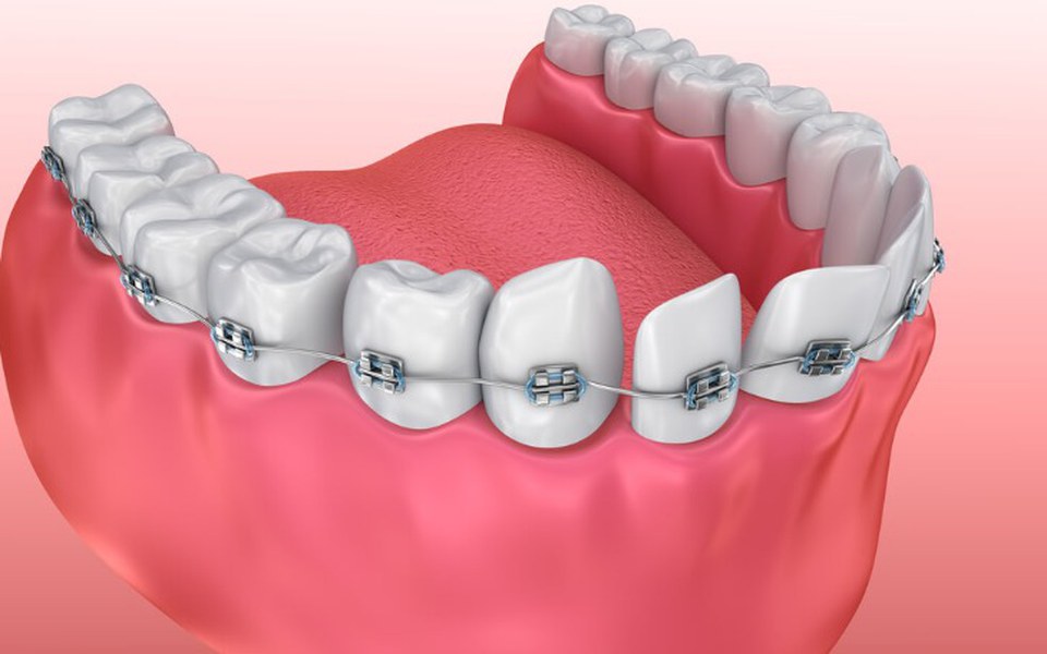 
        Zbiórka Zbiórka na aparat dentystyczny - zdjęcie główne
    