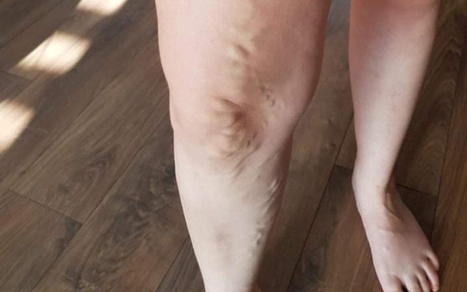 
        Zbiórka Zbiórka na operację żylaków - zdjęcie główne
    