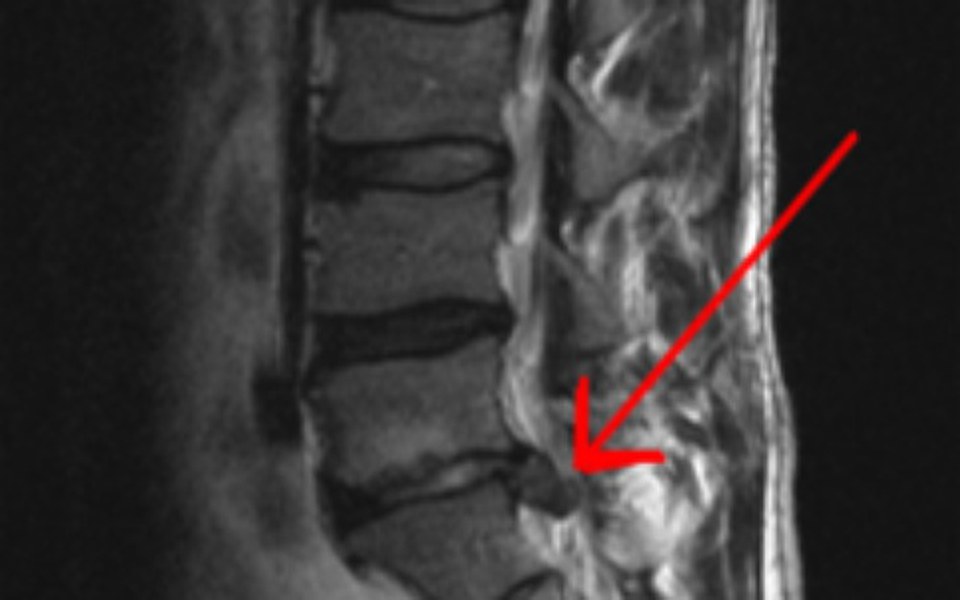 
        Zbiórka Operacja kręgosłupa męża - zdjęcie główne
    